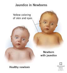 Jaundice in Newborn Babies