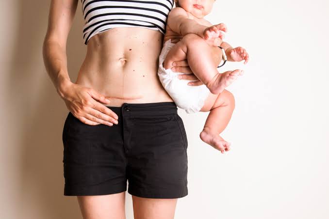 Indications for Caesarean Section (C-Section)